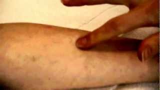 How to take a TB Skin Test [upl. by Sabina582]