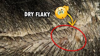 Dry Flaky Scalp Removal Dandruff Scratching Satisfying 310 [upl. by Yras868]