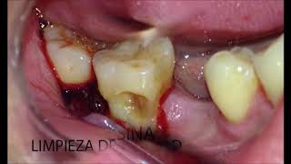 Tratamiento de caries radicular Interrelación PeriodonciaOperatoria dental [upl. by Obala]