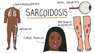 Understanding Sarcoidosis A Visual Guide for Students [upl. by Pirozzo844]