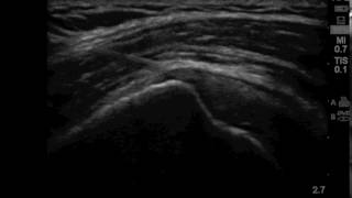 Video 5 SASDB Injection USPM Shoulder [upl. by Germana]