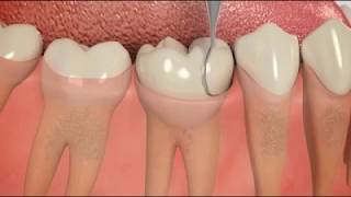 Deep Teeth Cleaning Recovery Tips How To Heal Fast [upl. by Gaige]