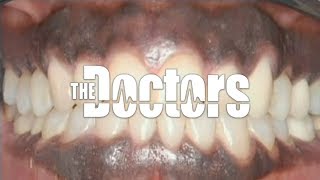 Dr Bill Dorfman Fixing Dark Gums on The Doctors [upl. by Wildee80]