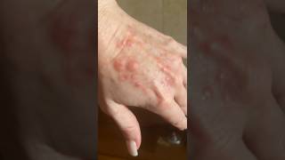 Sun Poisoning or Polymorphous Light Eruption Skin Rash [upl. by Eyatnod293]