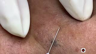 Big Cystic Acne Blackheads Extraction Blackheads amp Milia Whiteheads Removal Pimple Popping [upl. by Yrome]