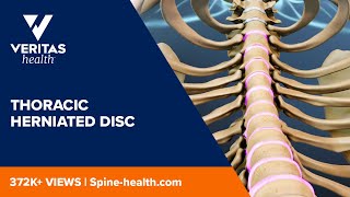 Thoracic Herniated Disc [upl. by Lledra500]