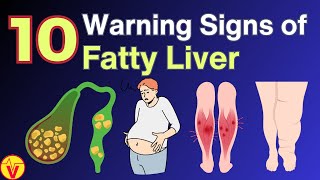 Fatty Liver Treatment  Fatty Liver Symptoms  Fatty Liver Diet  The Heath Show  Liver Detox [upl. by Ikim]