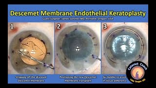 DMEK Descemet Membrane Endothelial Keratoplasty Corneal transplant of the inner layer [upl. by Greenwald516]