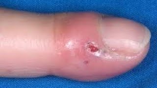 whitlow herpetic whitlow fingernail infection उंगलियों का पकना ayurveda विद्धकर्म [upl. by Koerlin]