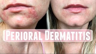 Perioral Dermatitis How I treated it [upl. by Eiramesor]