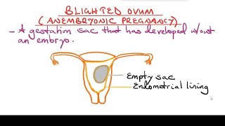 Blighted Ovum Anembryonic pregnancy [upl. by Trude19]