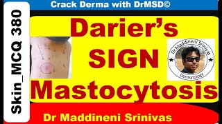 DARIERS SIGN  Mastocytosis  Urticaria Pigmentosa  Wheal  Histamine  Dermographism  DrMSD [upl. by Vernice]