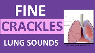 Crackles Fine Lung Sounds  Crackles and Rales Breath Sounds Abnormal [upl. by Aimej]