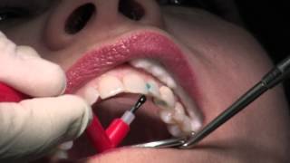 Composite Fillings [upl. by Ahseret]