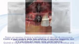 Rimozione e sostituzione vecchi impianti dentali [upl. by Apurk]