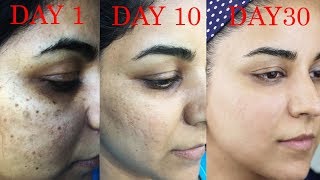 How I Got Rid of Dark Scars Hyperpigmentation PimplesAcne [upl. by Shelly]