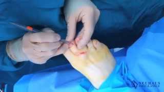 Cyst Removal Surgery Performed by Dr Matthew Neuhaus [upl. by Leiuqese608]