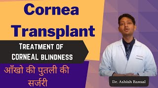 Cornea Transplant Eye Surgery Corneal Blindness treatment  आँखो की पुतली बदलने की सर्जरी [upl. by Zanas]