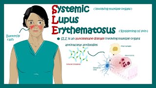 Systemic Lupus Erythematosus  signs and symptoms pathophysiology and diagnosis of Systemic Lupus [upl. by Nagaem454]