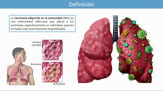 Neumonía Adquirida en la Comunidad en Adultos Según la GPC Mexicana [upl. by Isidor]