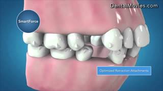 Invisalign G6 Clinical Innovations for First Premolars Extraction [upl. by Monarski866]