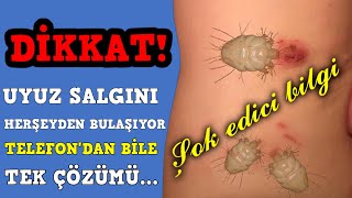 DİKKAT Uyuz vakaları arttıTek çözümü varCep Telefonundan bile bulaşıyorEn kolay tedavisi ne [upl. by Krigsman]