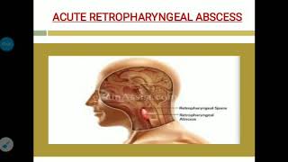 Acute and chronic retropharyngeal abscess [upl. by Ilrak]