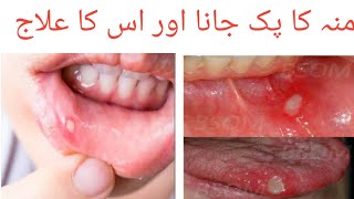 oral ulcer causes and treatment Aphthous ulcer Nilstat Dropsoral ulcer [upl. by Werna846]