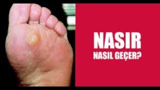 NASIR TEDAVİSİ NASIL YAPILIR NASIR BİR GÜNDE NASIL GEÇER [upl. by Enuahs535]