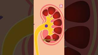 What Causes Kidney Stones  World Kidney Day Special shorts kidneystone worldkidneyday [upl. by Arlette]