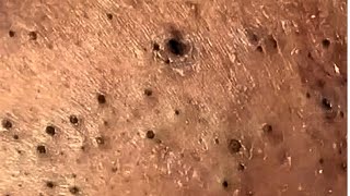 Ultimate Blackhead ASMR Compilation for Relaxation 07 satisfying asmr [upl. by Nerissa432]