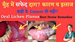 मुँह के अंदर सफ़ेद दाग कैसे ठीक करे  Oral Lichen Planus का घरेलू इलाज  Oral lichen Planus in Hindi [upl. by Idel773]