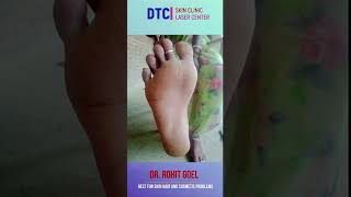 Porokeratosis  Dr Rohit Goel  DTCSKINCLINIC [upl. by Aerdua]