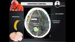 HEMATOMAS INTRACRANEALES EPIDURAL Y SUBDURAL  Como describir una Tomografía de cráneo [upl. by Nunciata975]