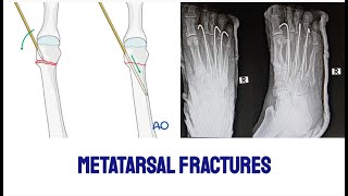 MULTIPLE METATARSAL FRACTURES IN A YOUNG MALE CRIF WITH K WIRES FIXATION AND MOBIISED IMMEDIATELY [upl. by Engis903]