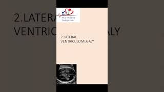 Lateral ventriculomegaly of fetal brain on antenatal scan ventriculomegaly [upl. by Ellehcor]