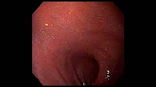 reflux oesophagitis withGastroduodenitis [upl. by Yreneh]