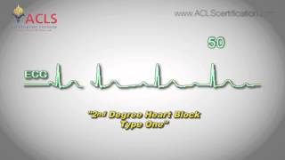 Second Degree Heart Block Type One by ACLS Certification Institute [upl. by Farhsa]