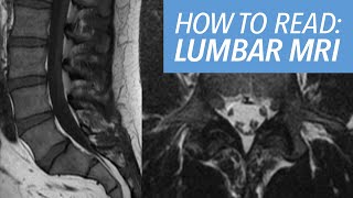 How I Read an MRI of the Lumbar Spine Sequences Search Pattern and Example Cases Explained [upl. by Nerradal]