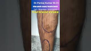 Laser treatment of varicose veins Varicose veins treatment in Ranchi varicose [upl. by Clippard]