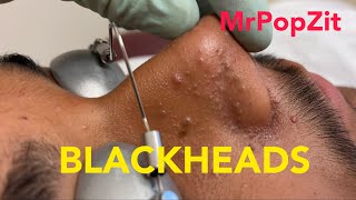 Tons of blackheads 17 minutes of extractionsBlackheads whiteheadsmilia Face and ears MrPopZit [upl. by Iralam]