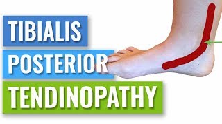 How to Get Rid of Posterior Tibial Tendonitis [upl. by Rusel205]