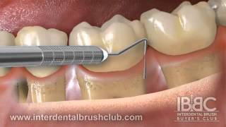 Periodontal disease causes and treatment [upl. by Nitsreik]