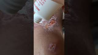 SIMPLE CLEANING OF WOUNDS USING HYDROGEN PEROXIDE  AGUA OXINADA [upl. by Ettelorahc]