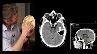 Paranasal sinuses CT imaging anatomy [upl. by Hootman]