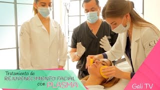 Tratamiento de Rejuvenecimiento facial con Plasma [upl. by Swithin]