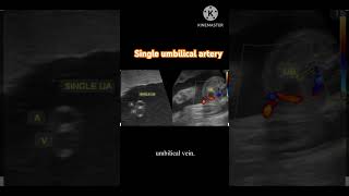 Single umbilical arterywhat is it sua [upl. by Eelrak]