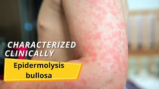 Epidermolysis bullosa  Symptoms and causes [upl. by Iveksarap870]