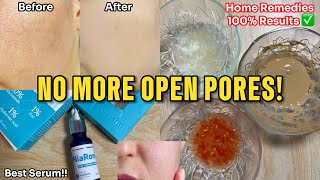 How to get Rid of Large Open Pores Best Home Remedies  Abial openpores [upl. by Rabassa]