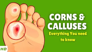 Corns amp Calluses – Causes Signs and Symptoms Diagnosis amp Treatment [upl. by Nosecyrb]